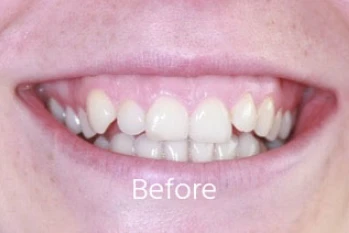 Before Teeth Straightening Case 3