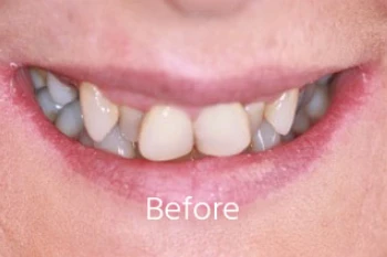 Before Teeth Straightening Case 4